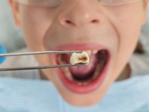 Best Broken or Cracked Tooth Emergency Dentist in Avonmore, PA