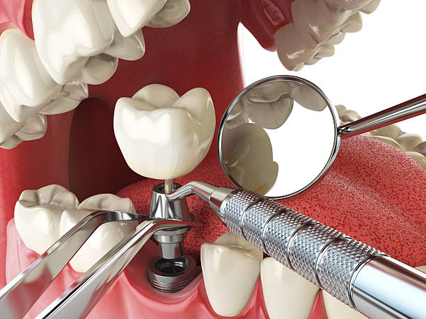 Best Emergency Dentist for Lost Fillings or Crowns in Avonmore, PA